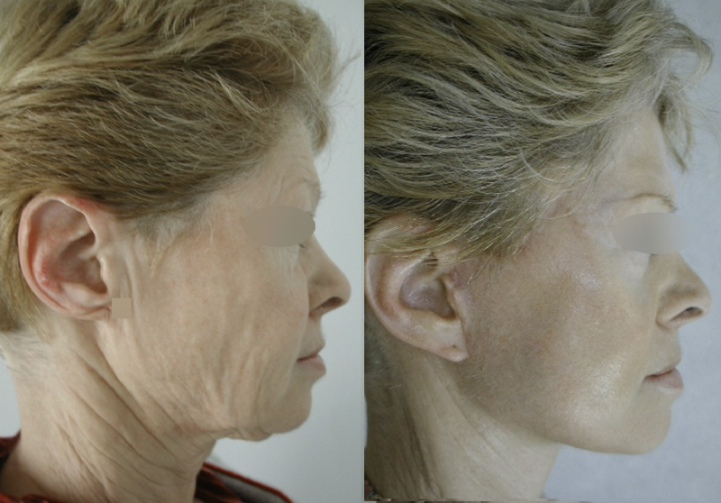 LE LIFTING  DU VISAGE ET DU COU CHEZ LA FEMME