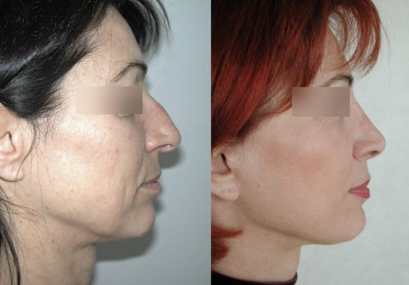 LE LIFTING  DU VISAGE ET DU COU CHEZ LA FEMME