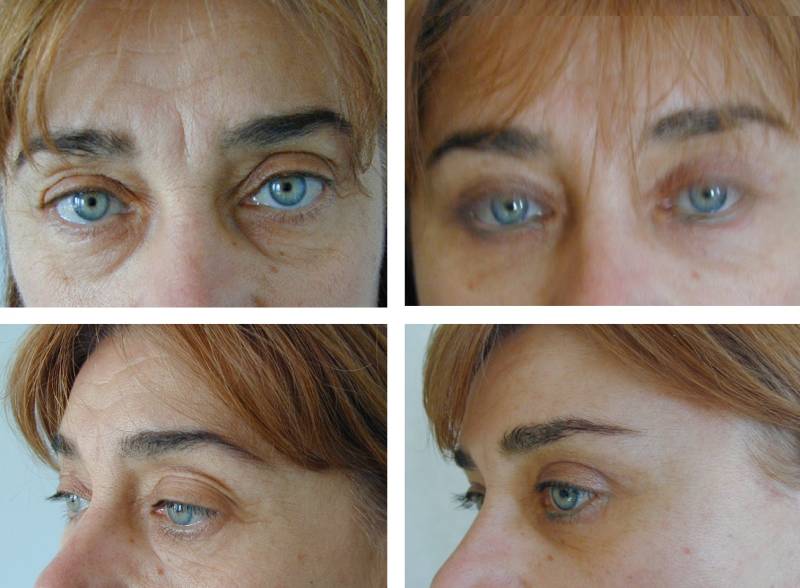 LIFTING TEMPORAL et CHIRURGIE DES PAUPIERES (BLEPHAROPLASTIES)
