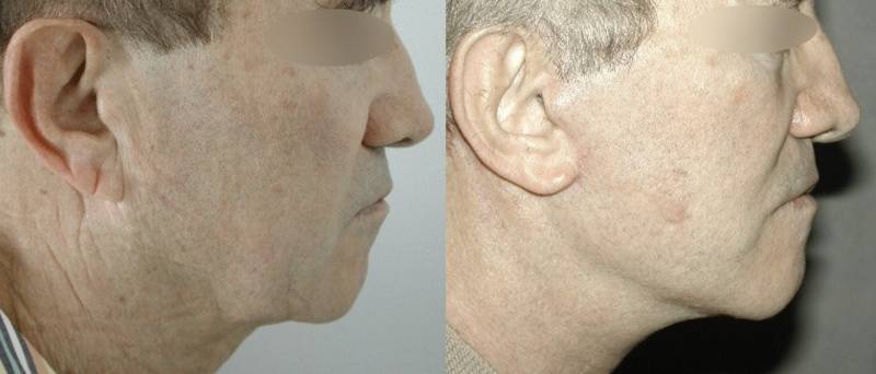 LIFTING CERVICO FACIAL CHEZ L'HOMME