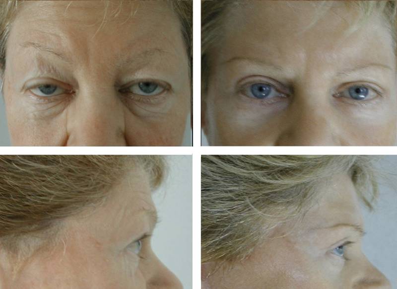 LIFTING TEMPORAL et CHIRURGIE DES PAUPIERES (BLEPHAROPLASTIES)