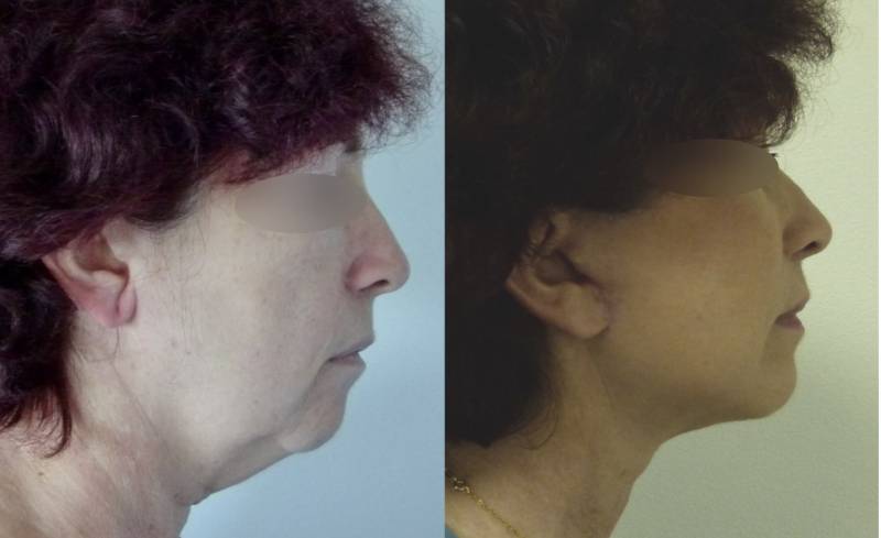 LE LIFTING  DU VISAGE ET DU COU CHEZ LA FEMME