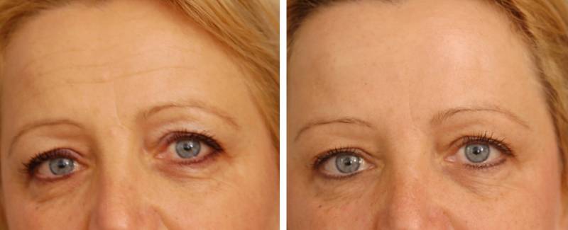 TOXINE BOTULIQUE et LIPOSTRUCTURE OU ACIDE HYALURONIQUE  Dr FOGLI  MARSEILLE