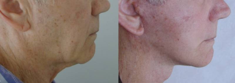 LIFTING   CHEZ L'HOMME