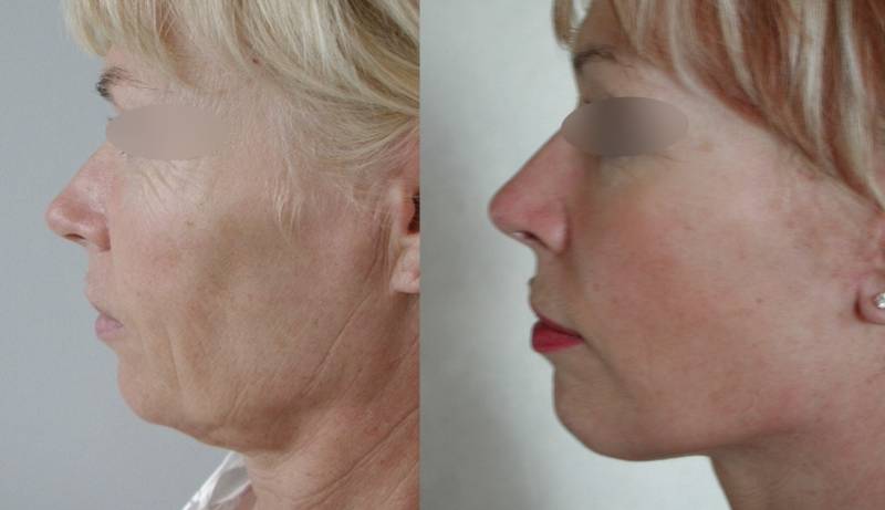 LE LIFTING  DU VISAGE ET DU COU CHEZ LA FEMME