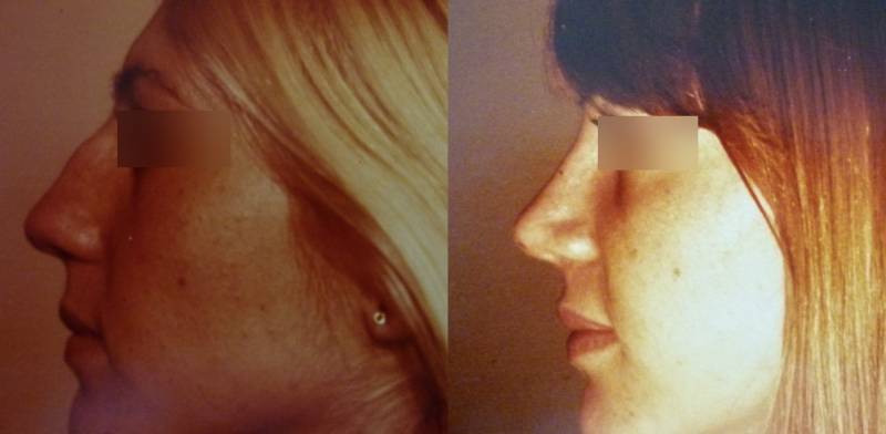 CHIRURGIE ESTHETIQUE DU NEZ OU RHINOPLASTIE