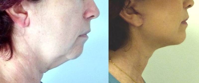 CHIRURGIE DE l'ANGLE CERVICO MENTONNIER ET DU MENTON