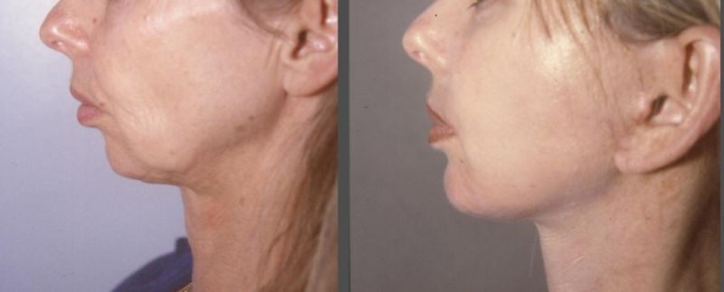 LE LIFTING  DU VISAGE ET DU COU CHEZ LA FEMME